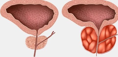 La prostata è sana e infiammata
