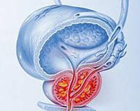 Infiammazione della prostata con prostatite