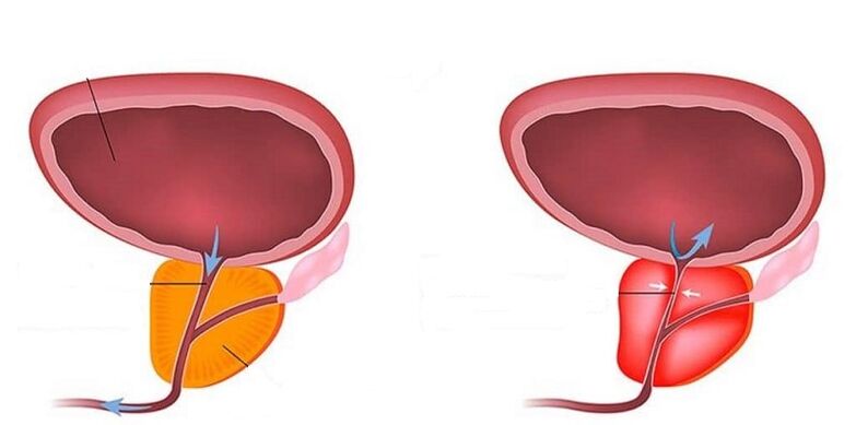 Prostata sana e infiammata con prostatite