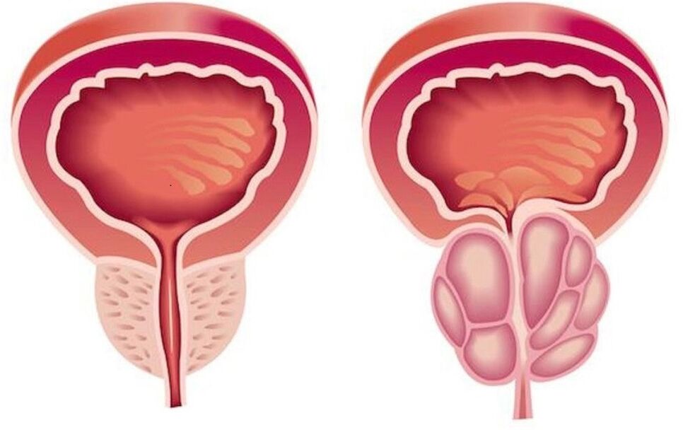prostata sana e infiammata con prostatite