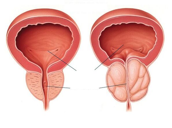 prostata normale e ingrossata